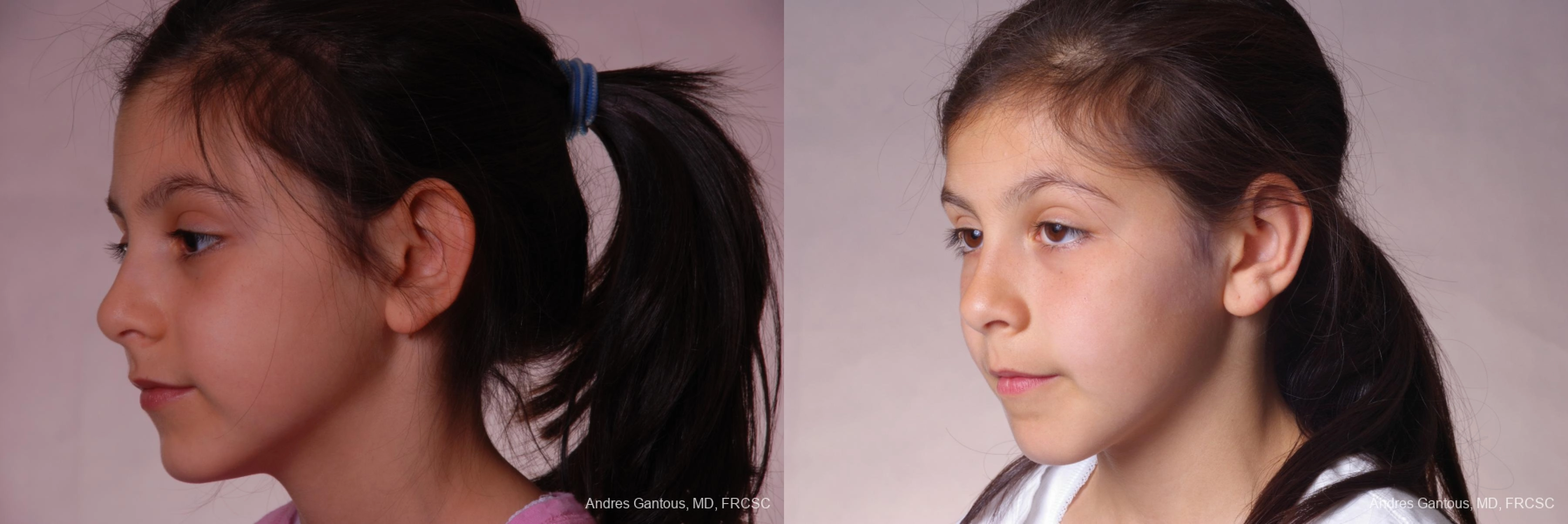 Otoplasty and Earlobe Repair - Thumbnail 4