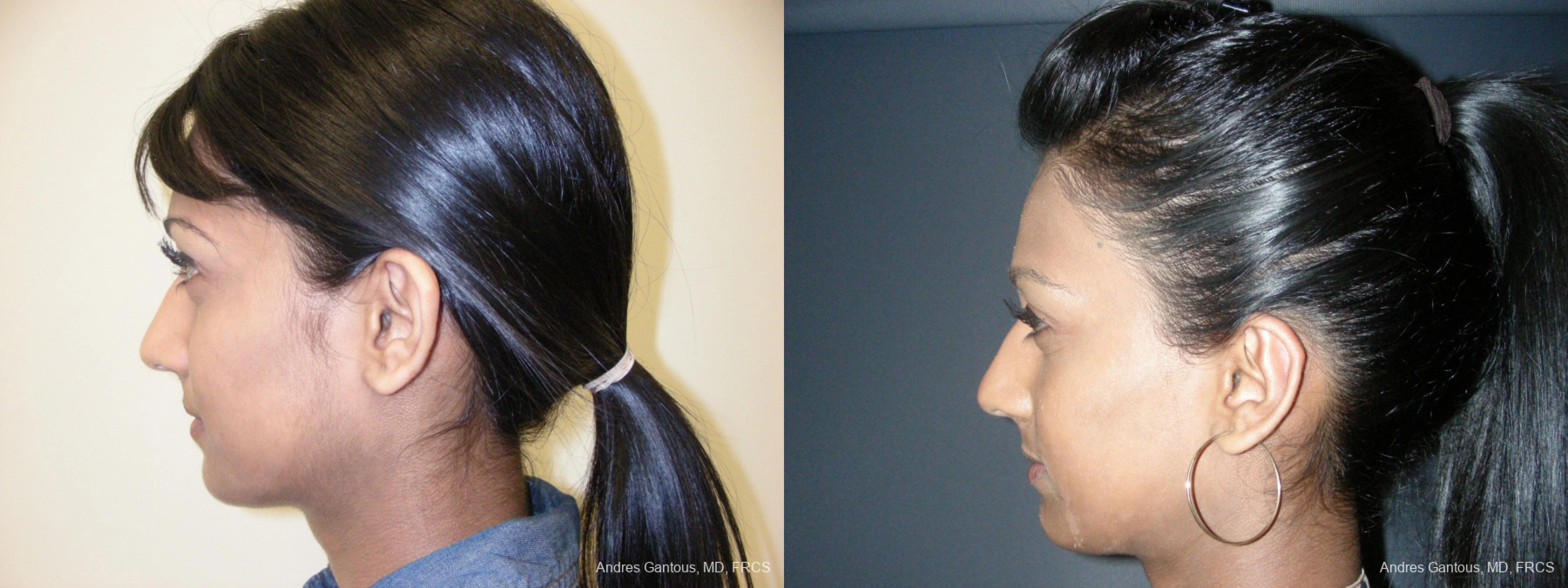 Otoplasty and Earlobe Repair - Thumbnail 5