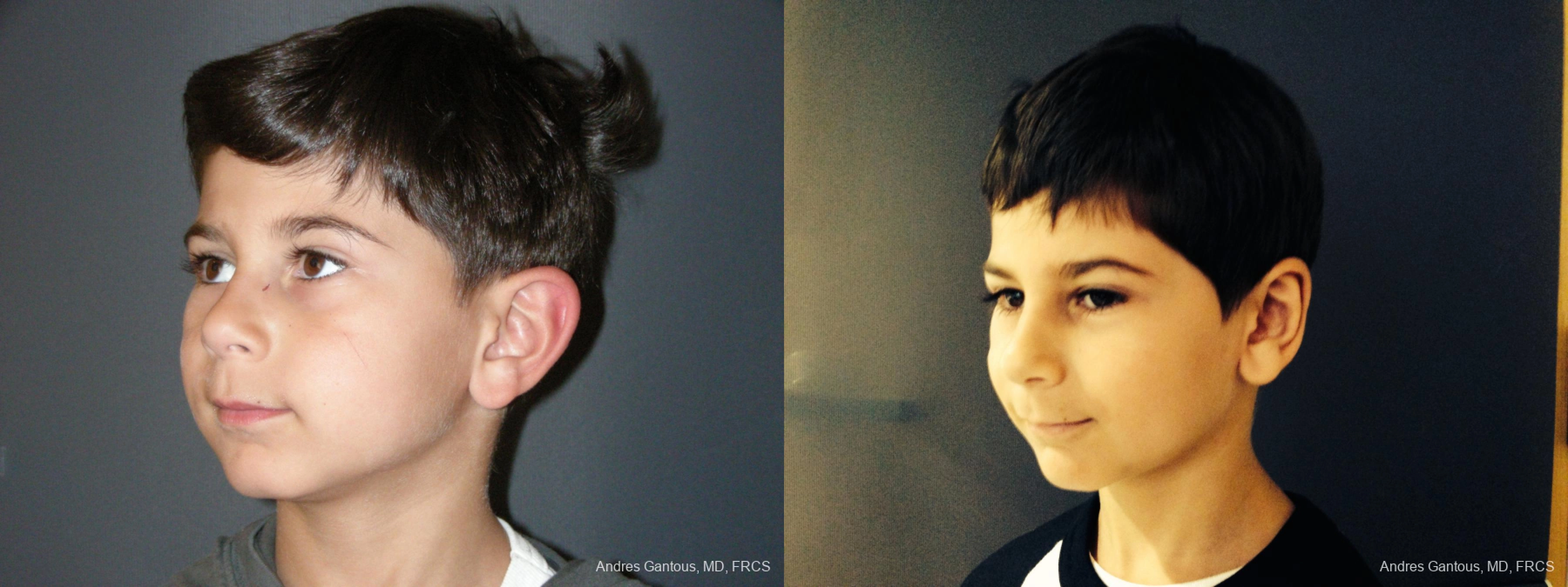 Otoplasty and Earlobe Repair - Thumbnail 4