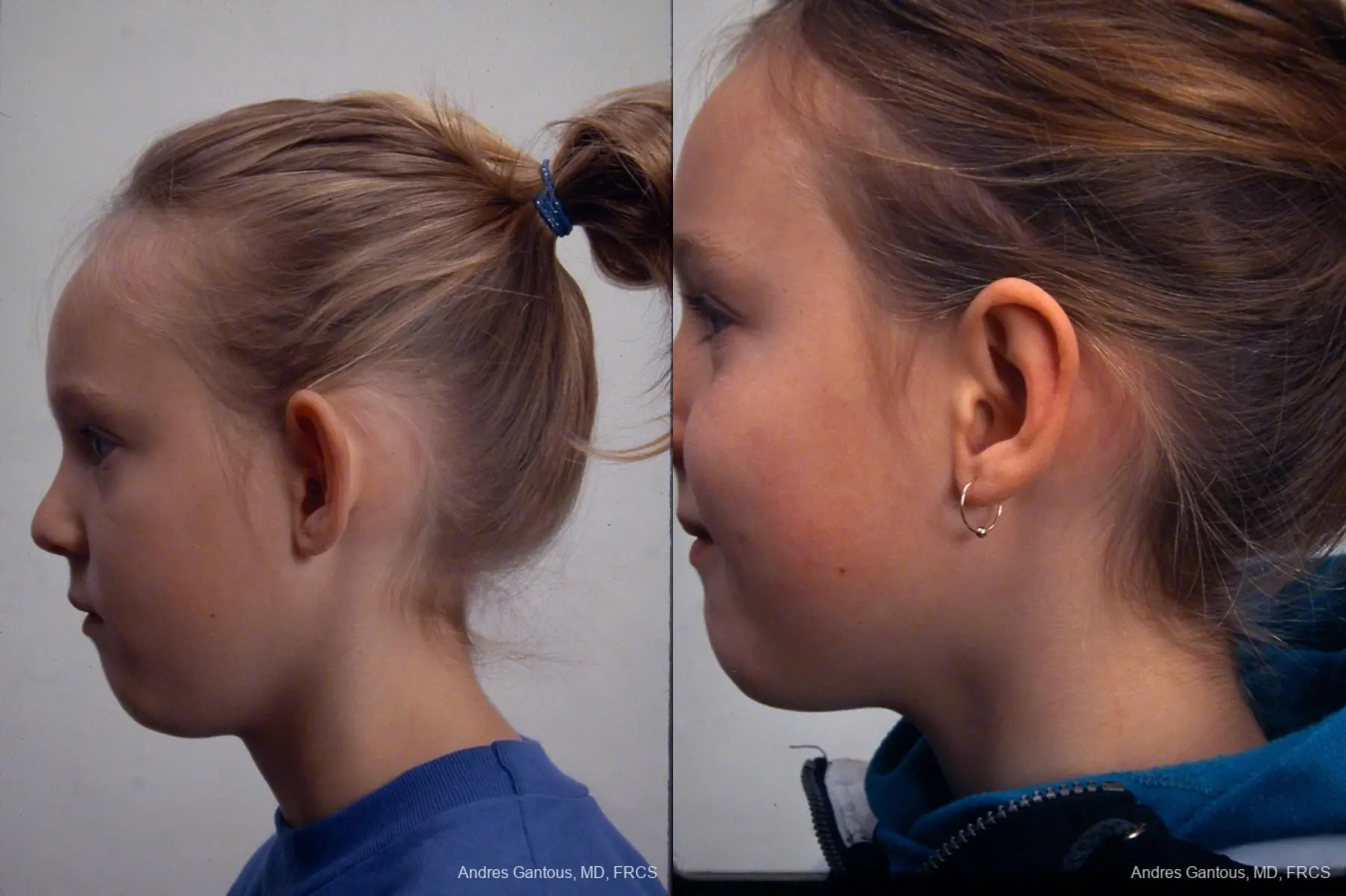 Otoplasty And Earlobe Repair: Patient 23 - Before and After 3
