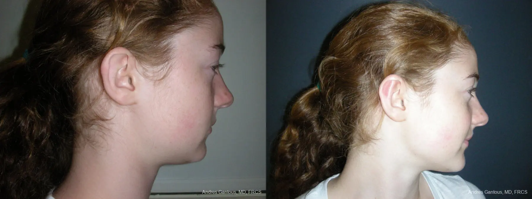 Otoplasty And Earlobe Repair: Patient 28 - Before and After 3