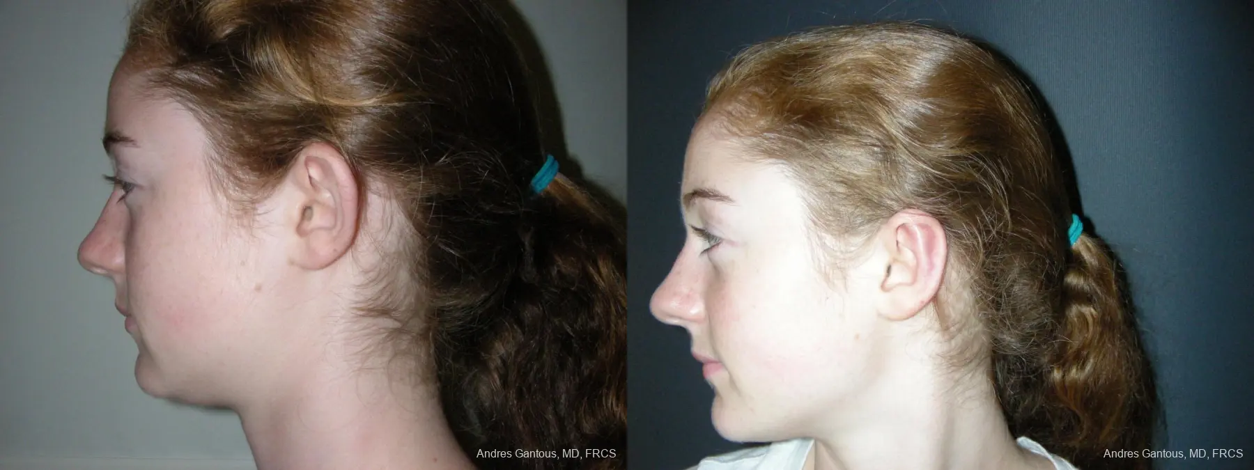 Otoplasty And Earlobe Repair: Patient 28 - Before and After 5