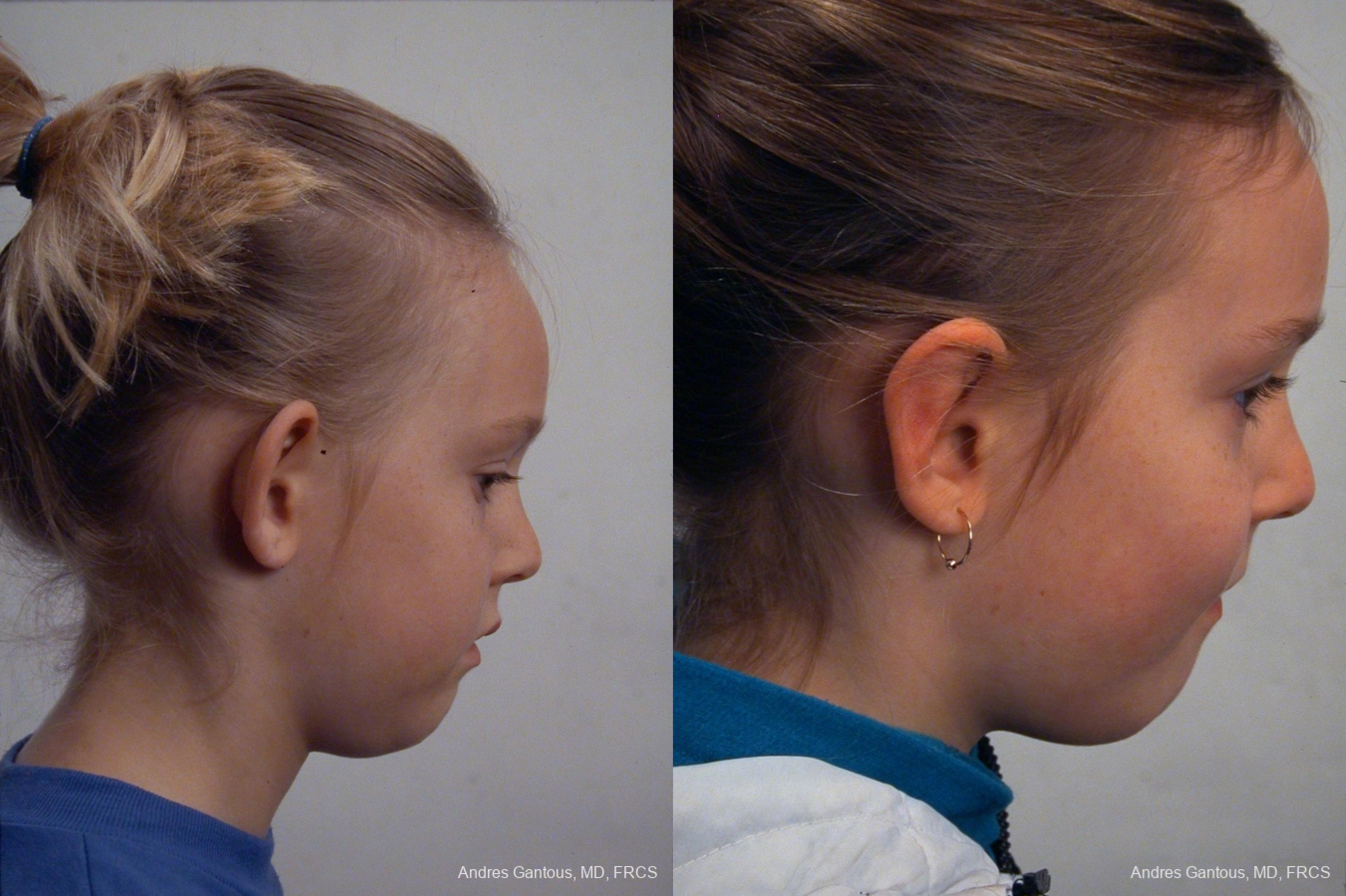 Otoplasty and Earlobe Repair - Thumbnail 2