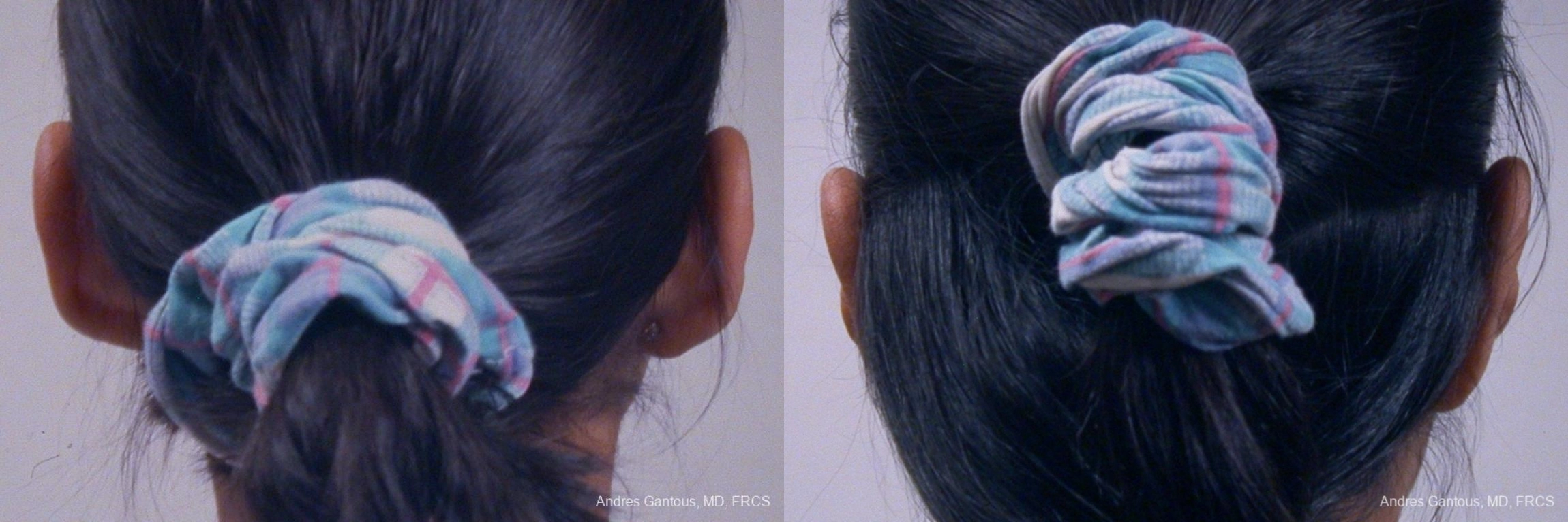 Otoplasty and Earlobe Repair - Thumbnail 6