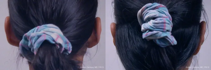 Otoplasty And Earlobe Repair: Patient 25 - Before and After 6