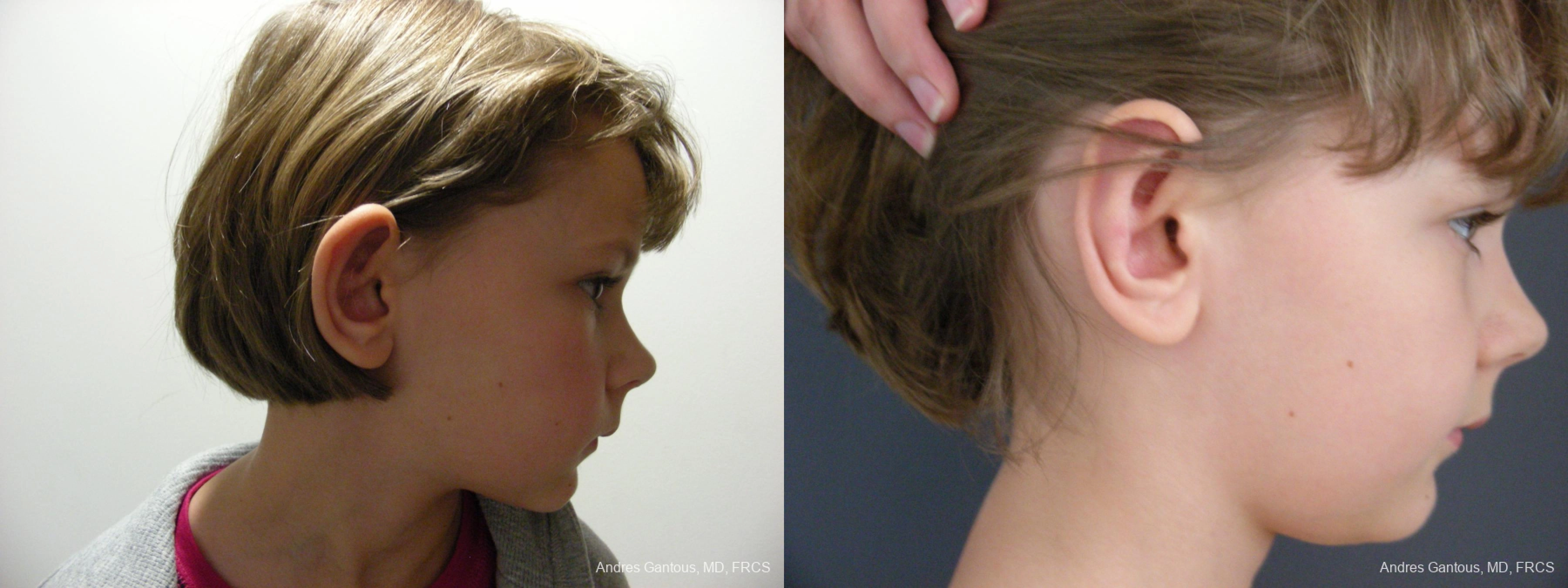 Otoplasty and Earlobe Repair - Thumbnail 3