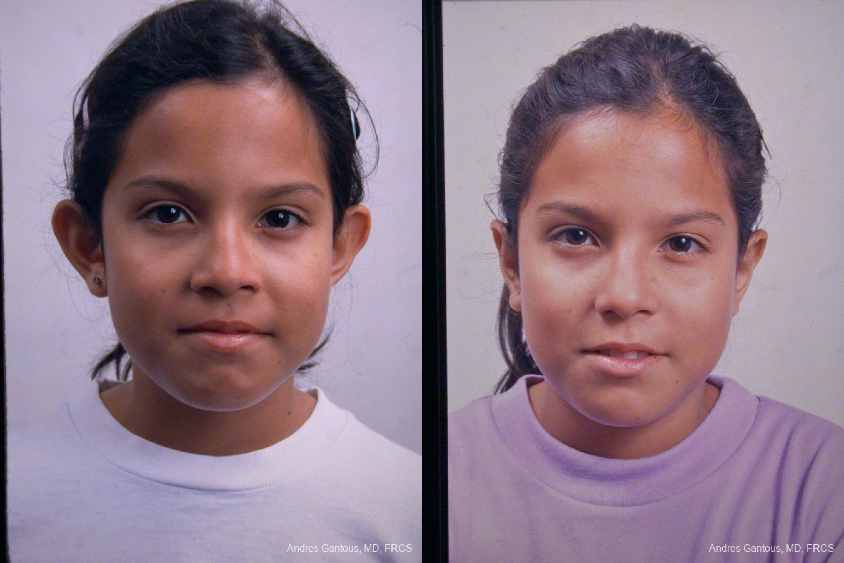 Otoplasty and Earlobe Repair - Case 11675