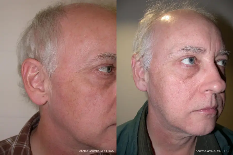 Otoplasty And Earlobe Repair: Patient 24 - Before and After 2