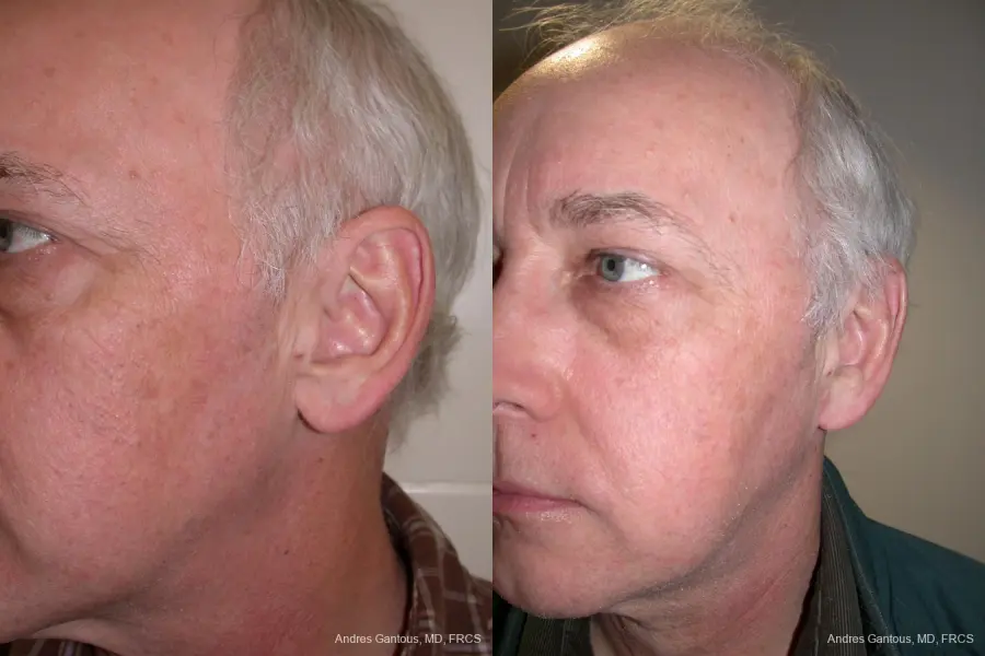 Otoplasty And Earlobe Repair: Patient 24 - Before and After 4
