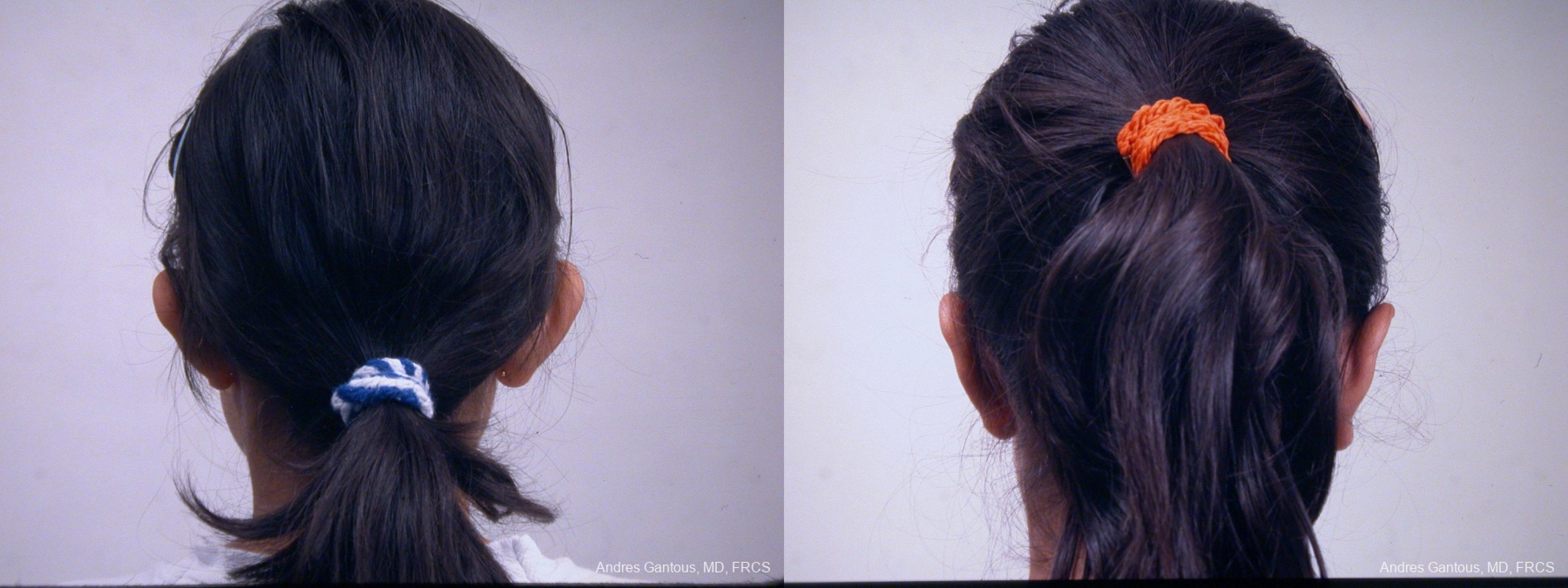 Otoplasty and Earlobe Repair - Thumbnail 4