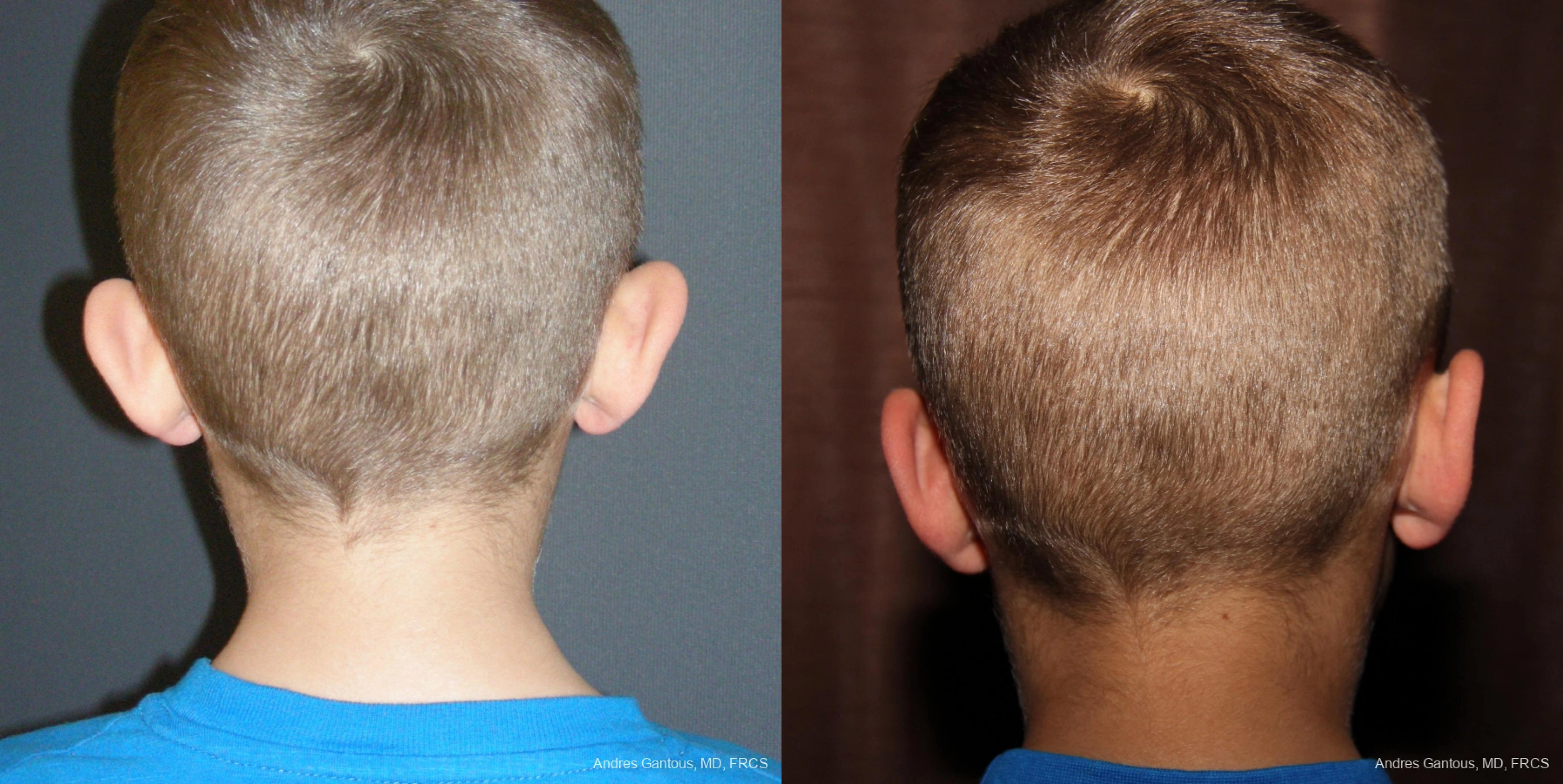 Otoplasty and Earlobe Repair - Thumbnail 2