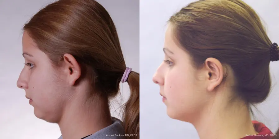 Otoplasty And Earlobe Repair: Patient 15 - Before and After 2