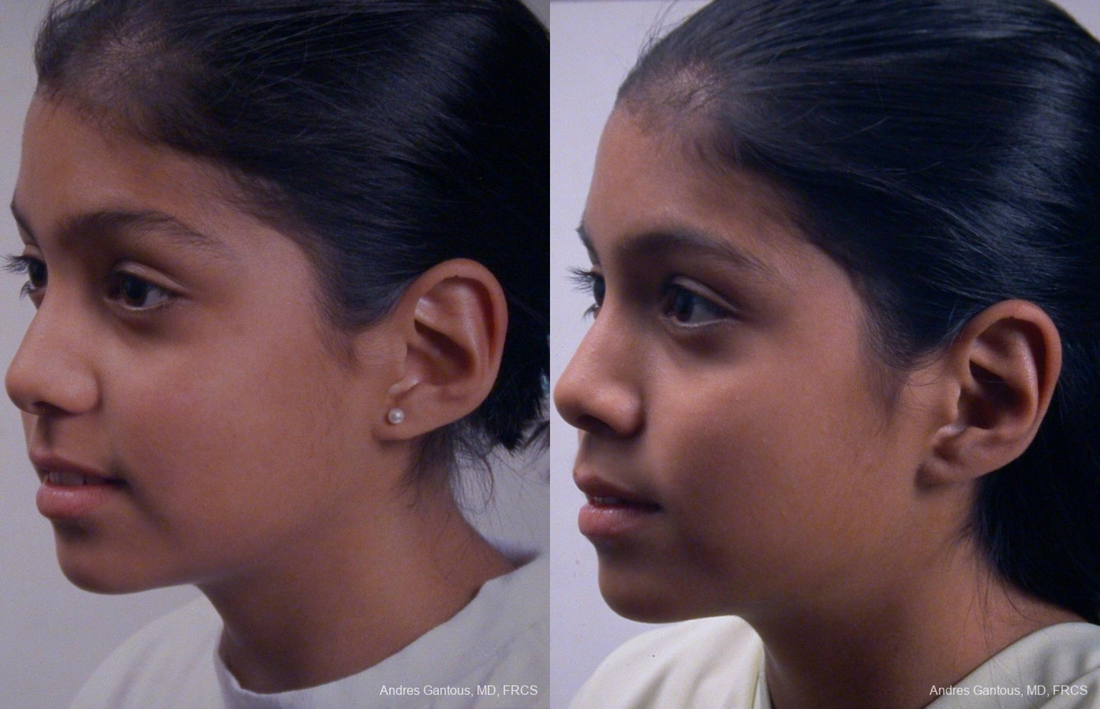 Otoplasty and Earlobe Repair - Thumbnail 4