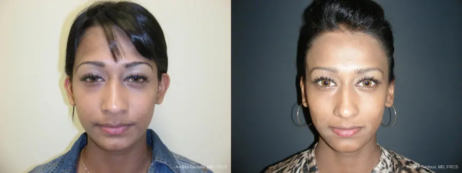 Otoplasty And Earlobe Repair: Patient 19 - Before and After