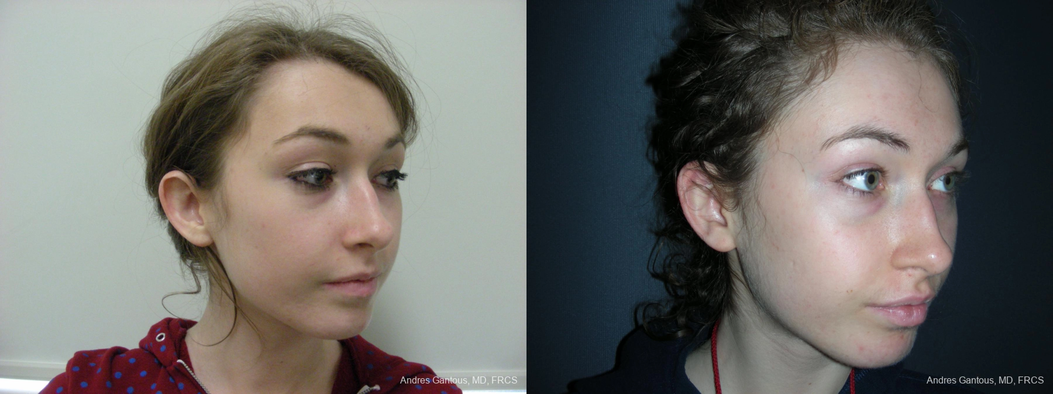 Otoplasty and Earlobe Repair - Thumbnail 2