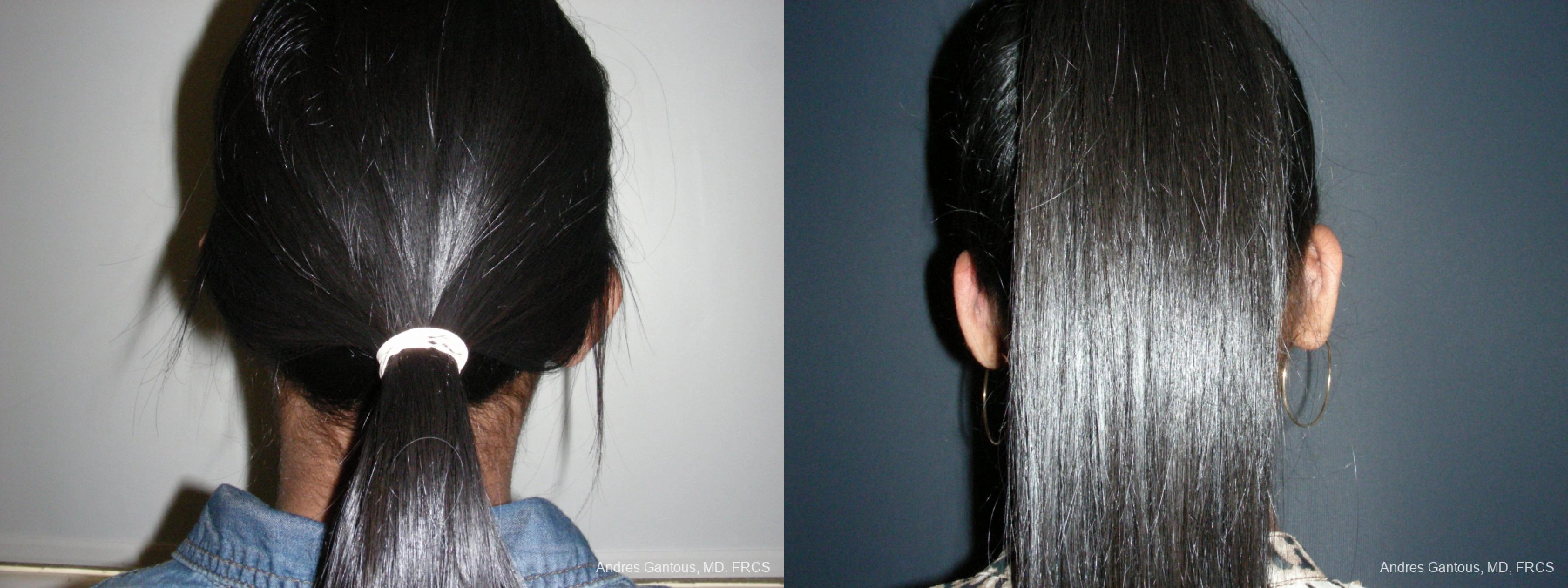 Otoplasty and Earlobe Repair - Thumbnail 6