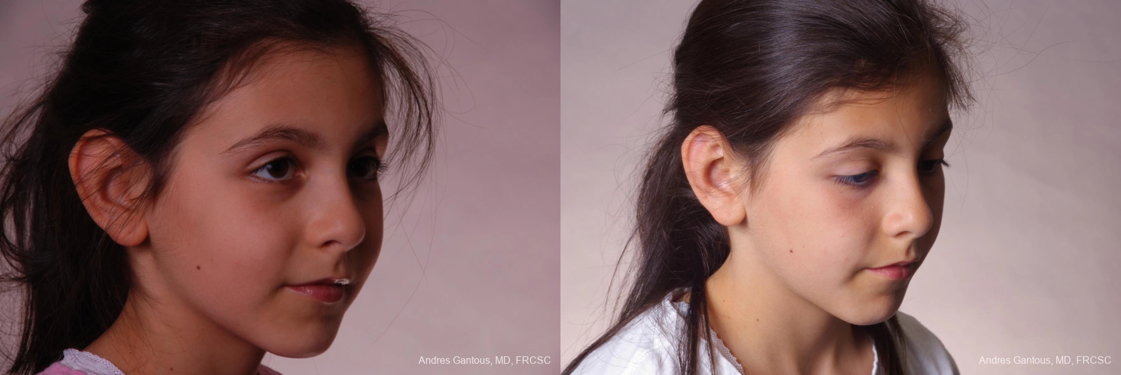 Otoplasty and Earlobe Repair - Thumbnail 2