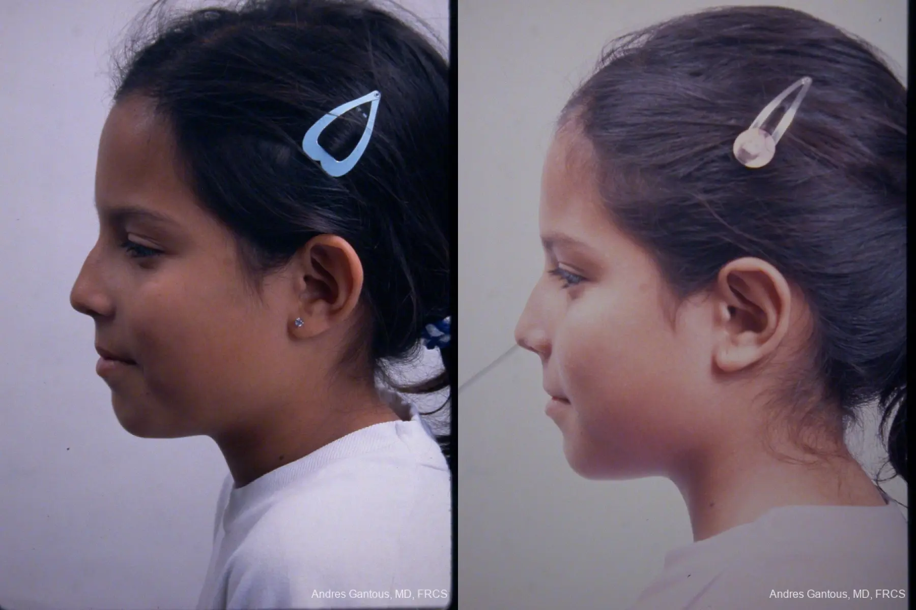 Otoplasty And Earlobe Repair: Patient 4 - Before and After 3