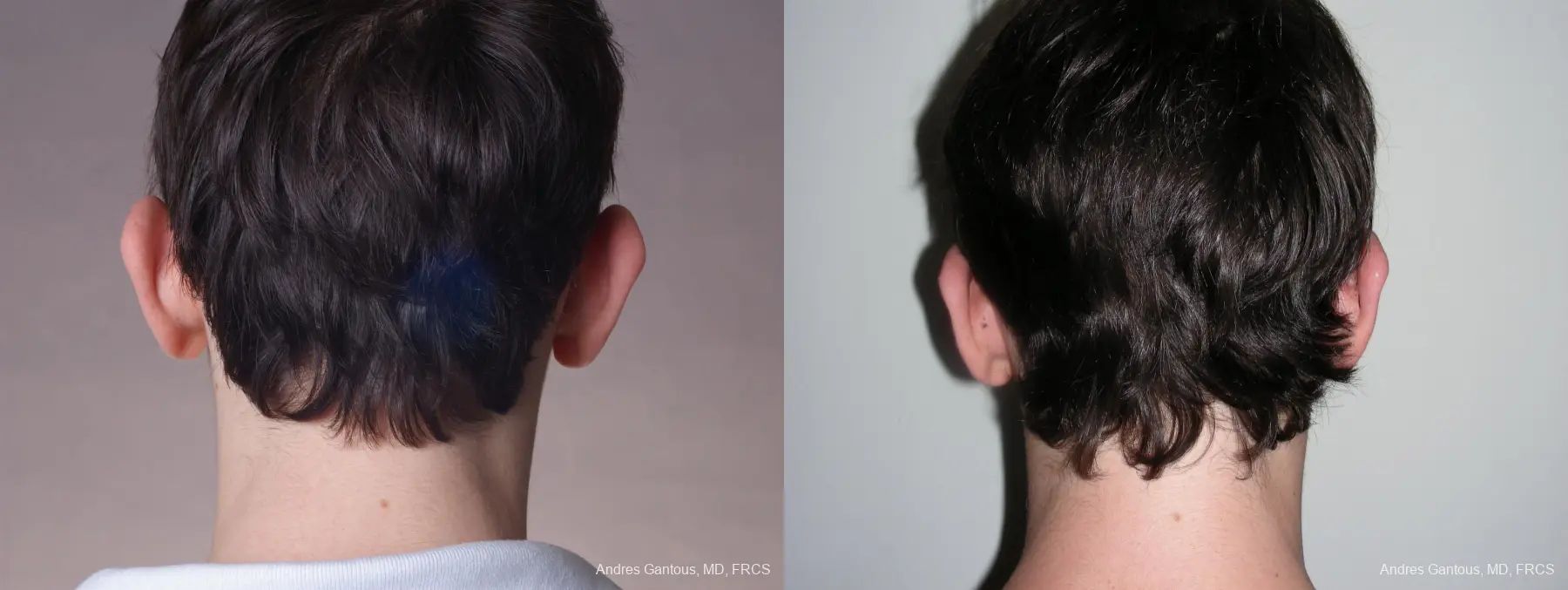Otoplasty And Earlobe Repair: Patient 3 - Before and After 6