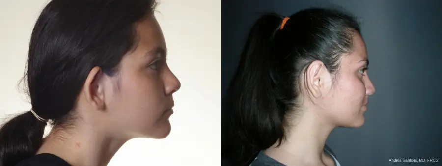 Otoplasty And Earlobe Repair: Patient 20 - Before and After 3