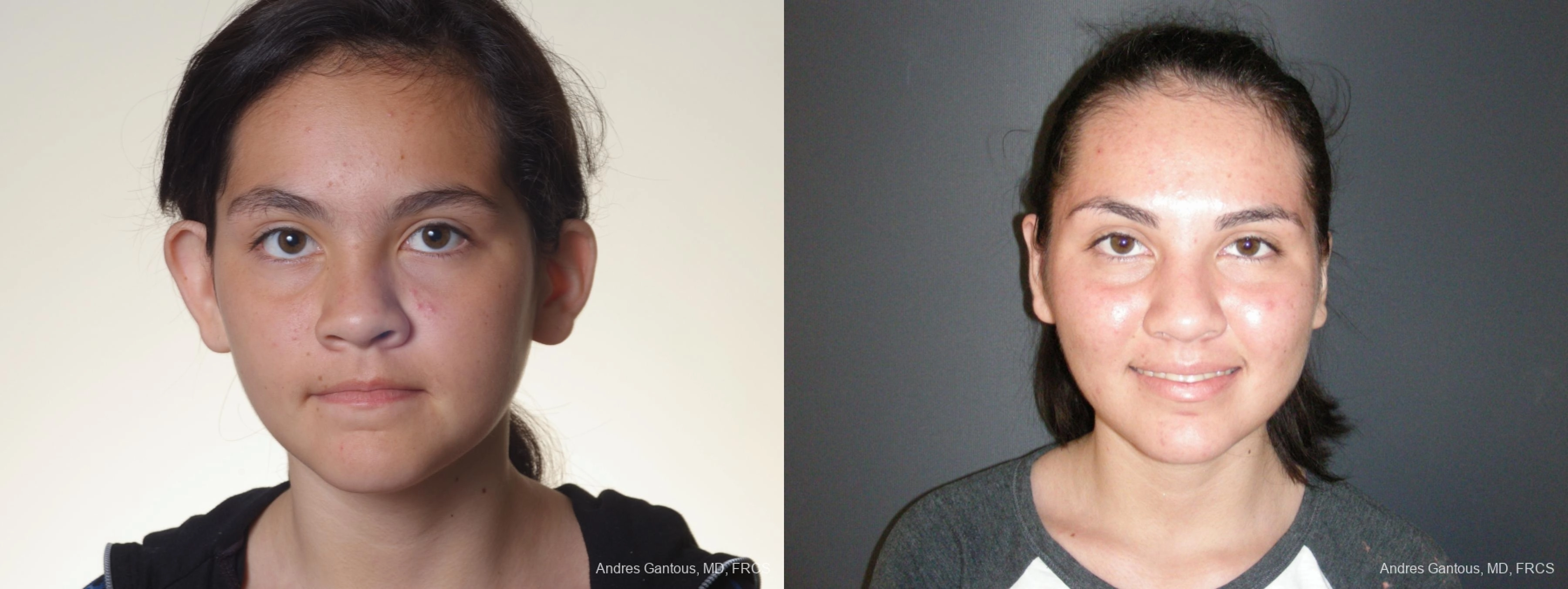 Otoplasty and Earlobe Repair - Case 11716