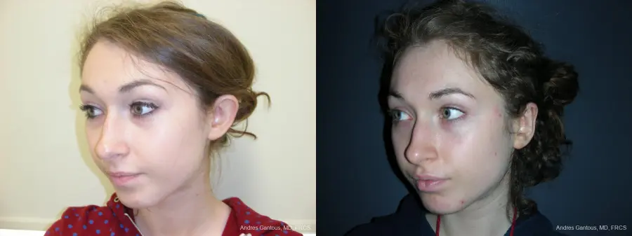 Otoplasty And Earlobe Repair: Patient 22 - Before and After 4