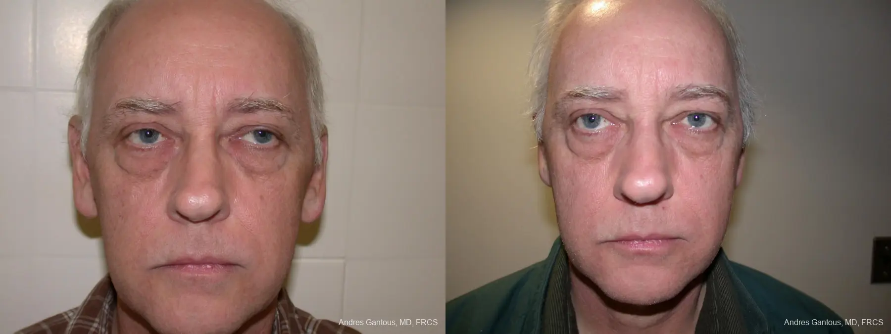 Otoplasty And Earlobe Repair: Patient 24 - Before and After 1