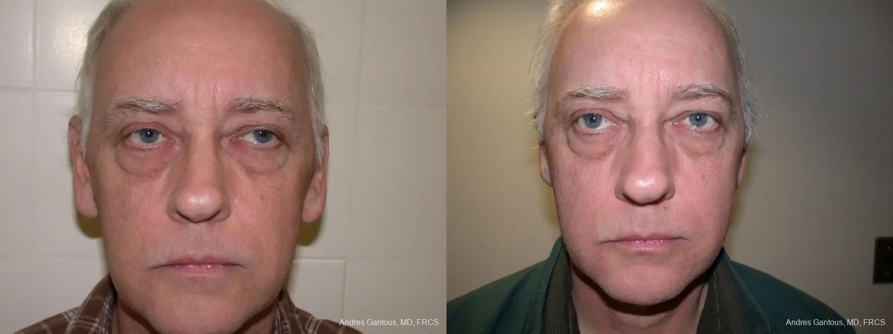 Otoplasty And Earlobe Repair: Patient 24 - Before and After  