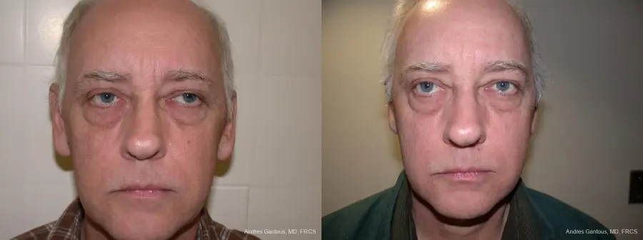 Otoplasty And Earlobe Repair: Patient 24 - Before and After