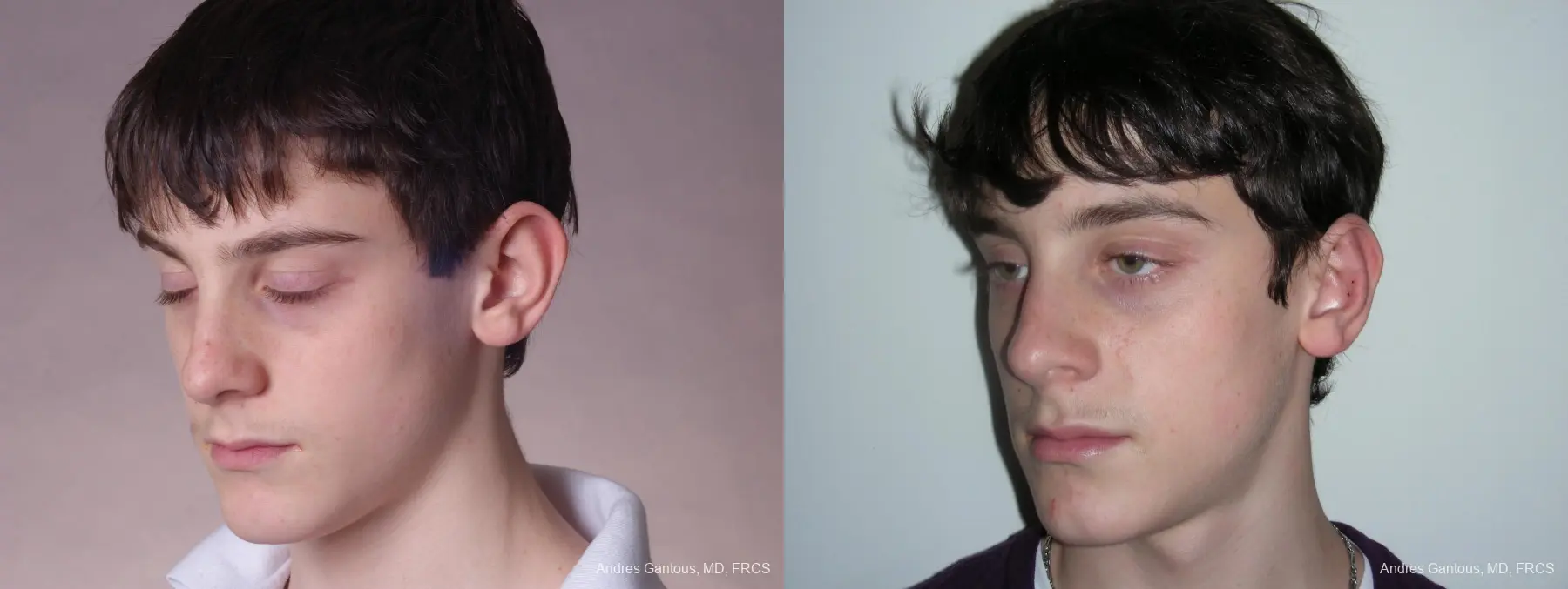 Otoplasty And Earlobe Repair: Patient 3 - Before and After 4