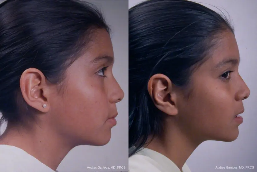Otoplasty And Earlobe Repair: Patient 25 - Before and After 3