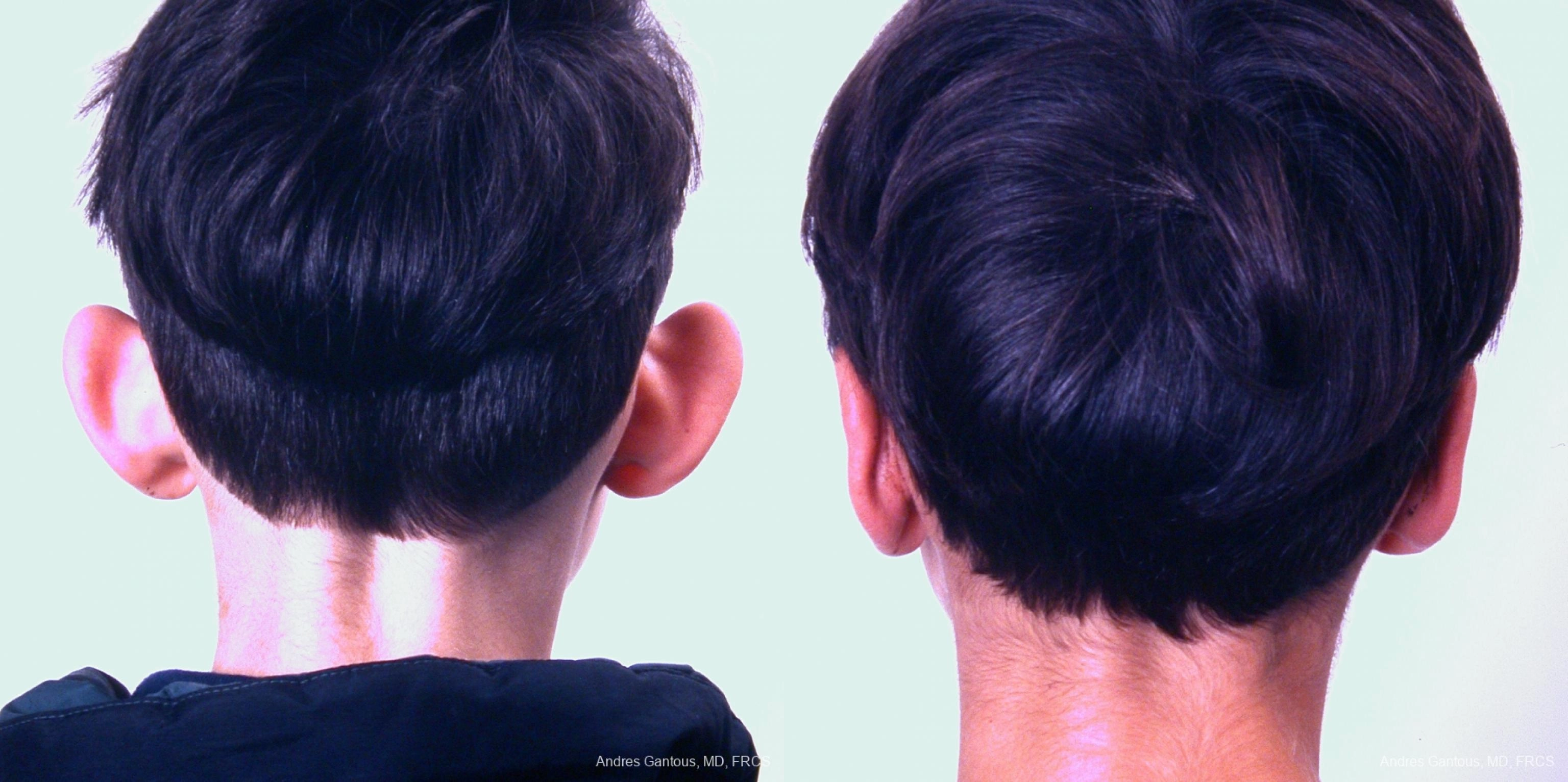 Otoplasty and Earlobe Repair - Thumbnail 2