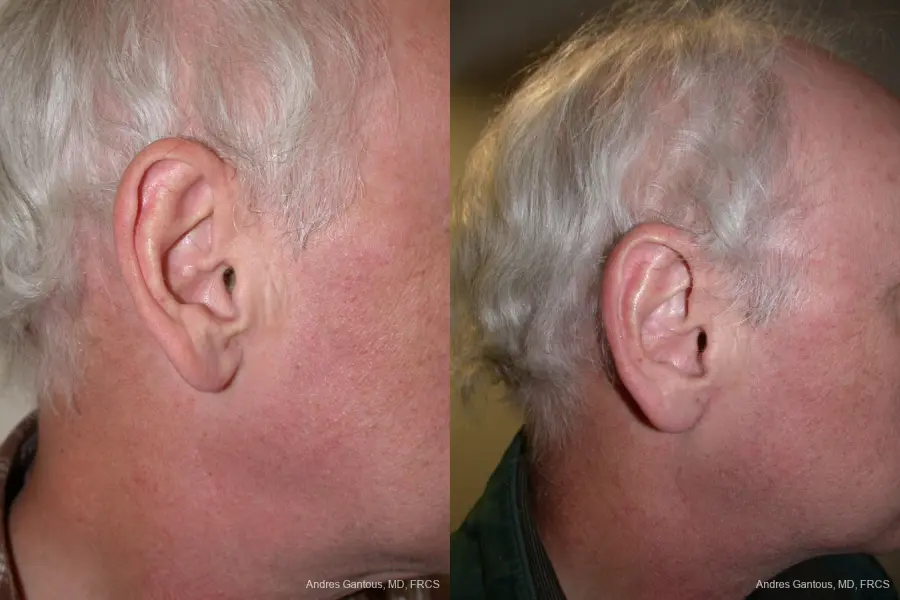 Otoplasty And Earlobe Repair: Patient 24 - Before and After 3
