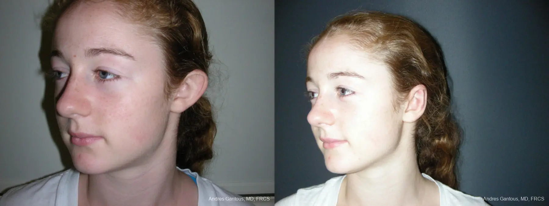 Otoplasty And Earlobe Repair: Patient 28 - Before and After 4