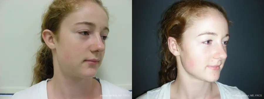 Otoplasty And Earlobe Repair: Patient 28 - Before and After 2