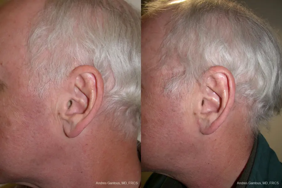 Otoplasty And Earlobe Repair: Patient 24 - Before and After 5