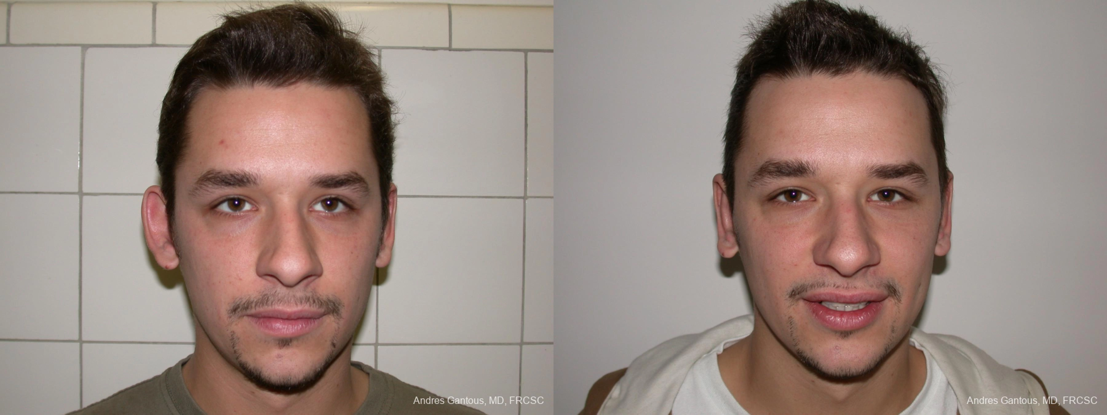 Otoplasty and Earlobe Repair - Case 11672