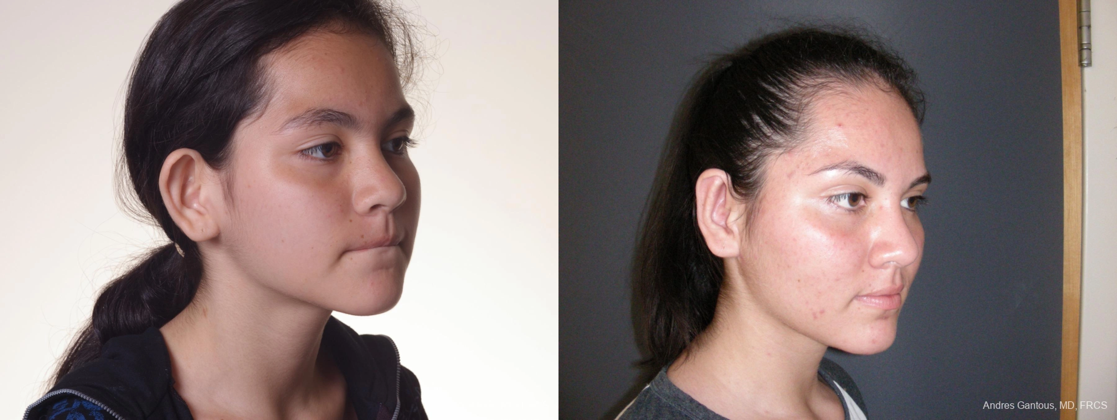 Otoplasty and Earlobe Repair - Thumbnail 2