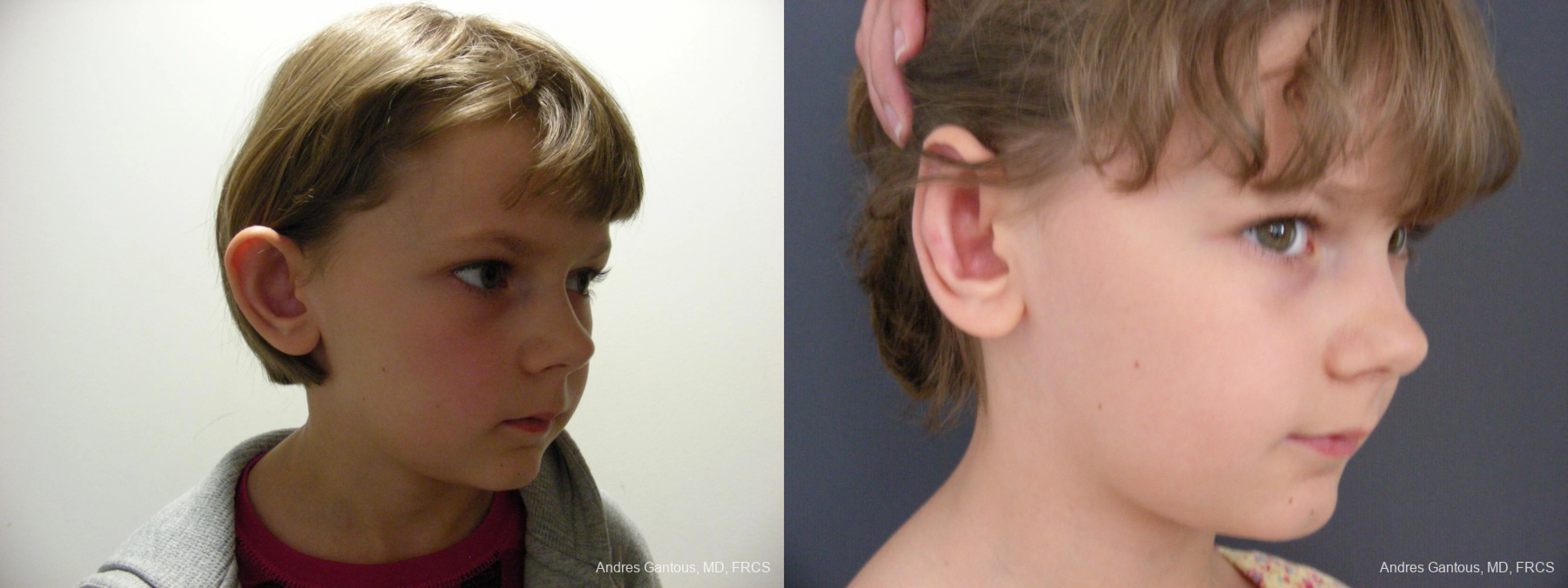 Otoplasty and Earlobe Repair - Thumbnail 2