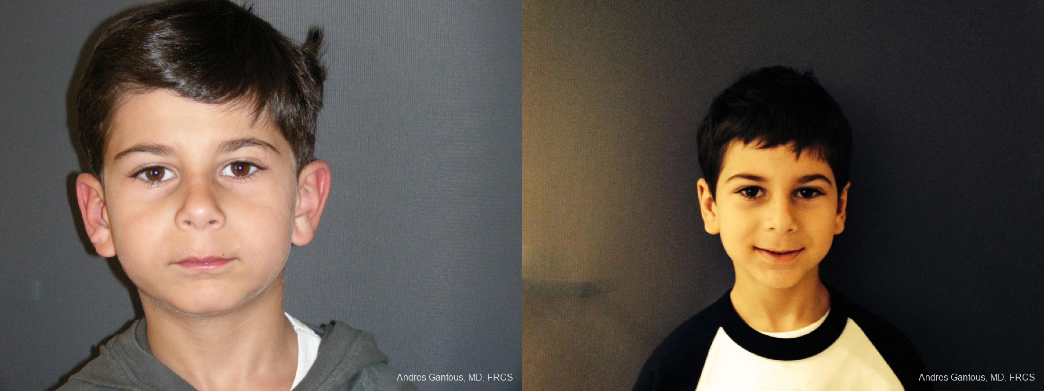 Otoplasty and Earlobe Repair - Case 11725
