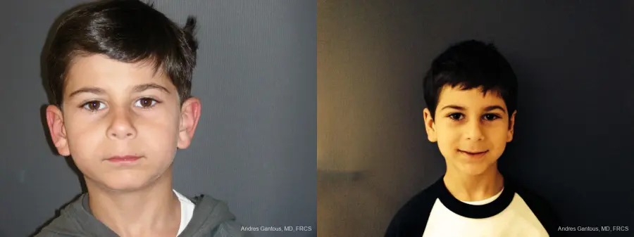 Otoplasty And Earlobe Repair: Patient 29 - Before and After