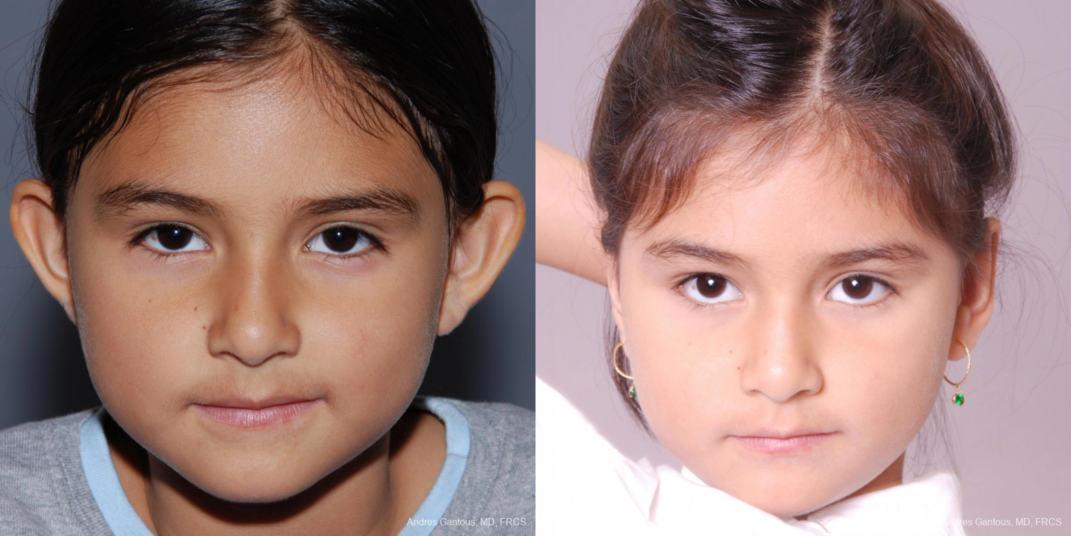 Otoplasty and Earlobe Repair - Case 6550