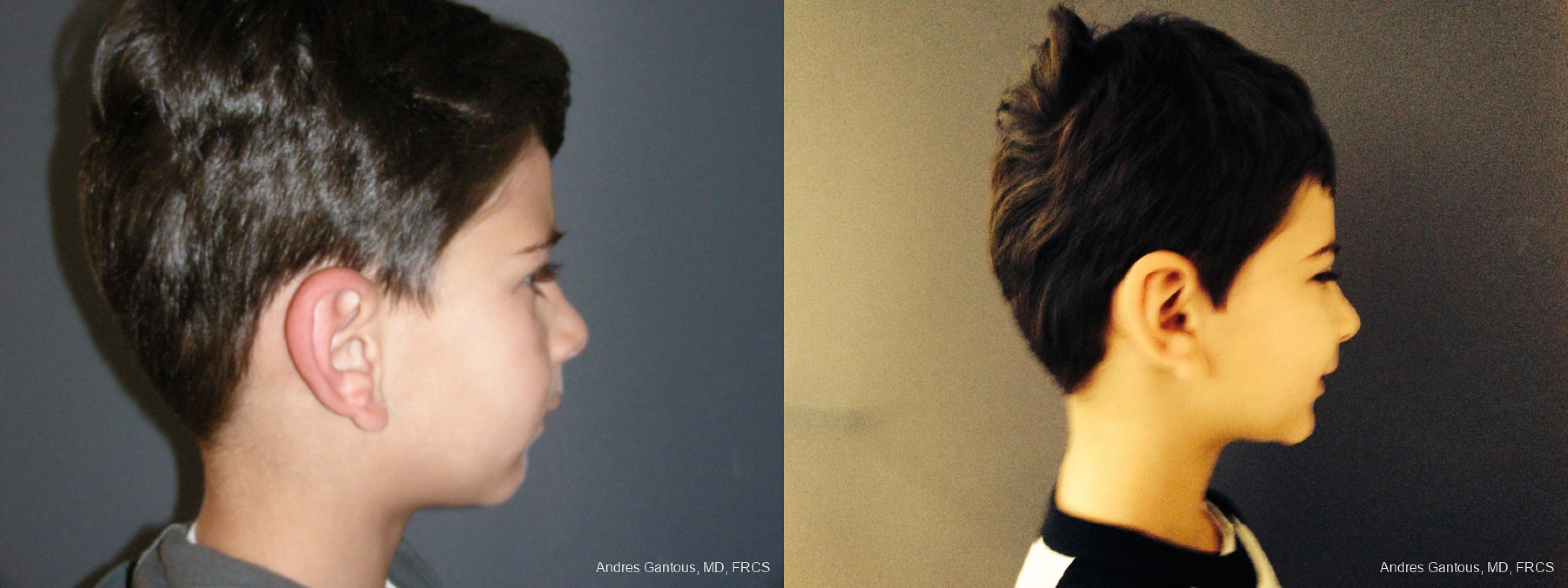 Otoplasty and Earlobe Repair - Thumbnail 3