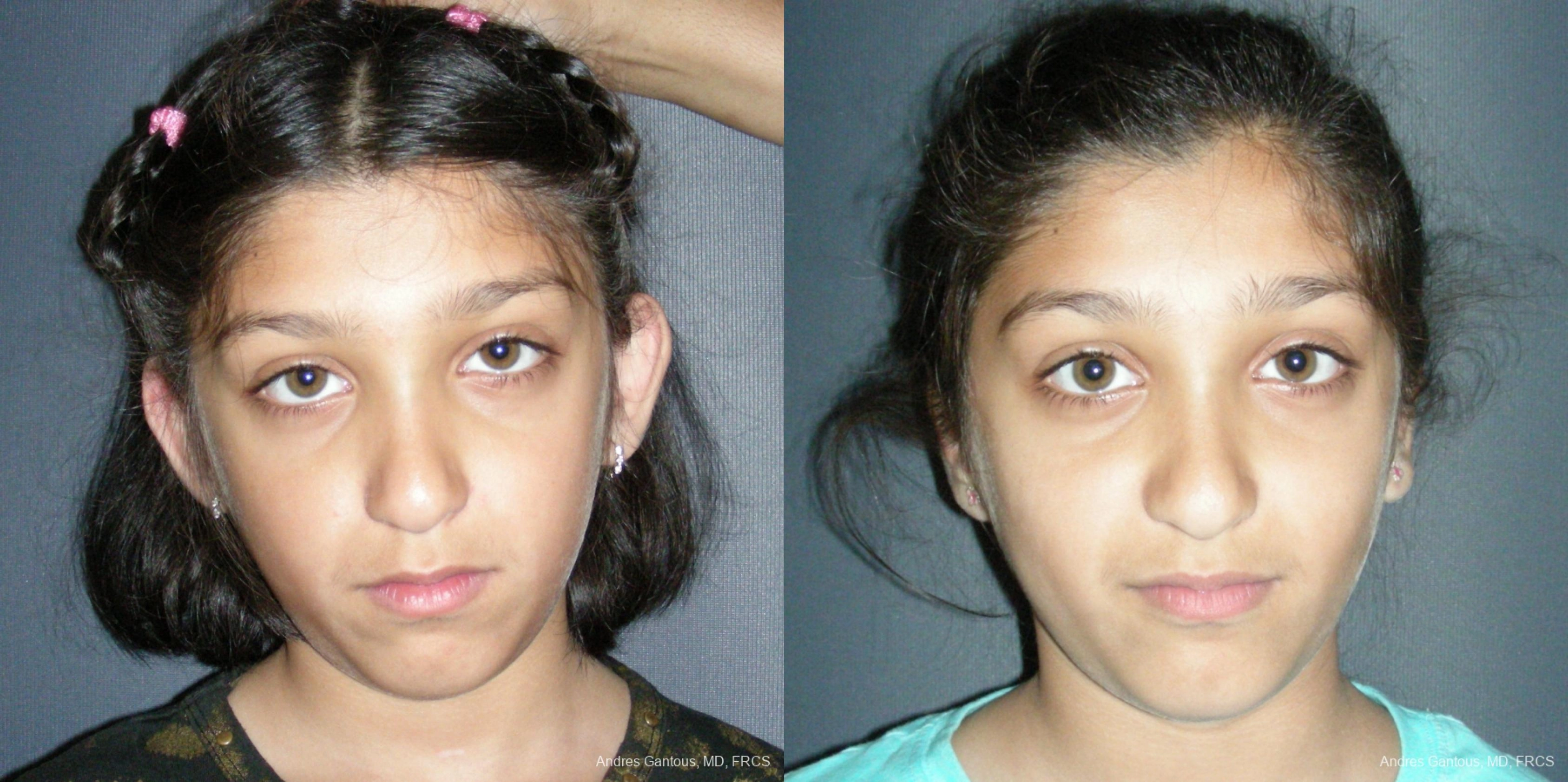 Otoplasty and Earlobe Repair - Case 6561