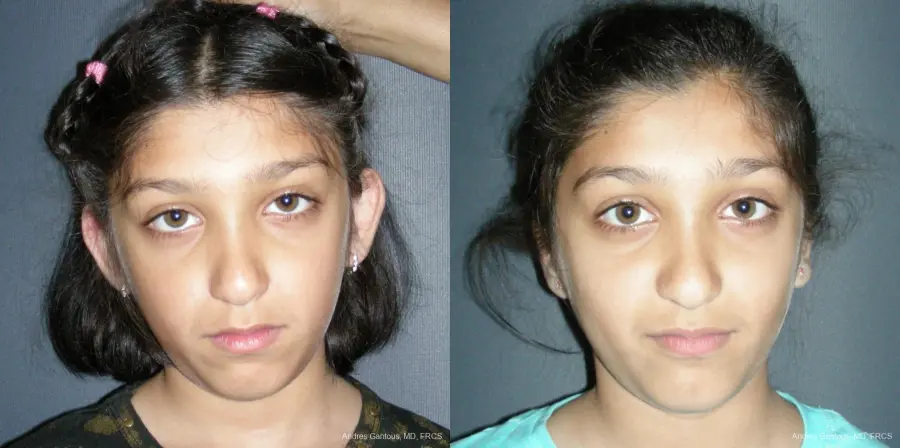 Otoplasty And Earlobe Repair: Patient 18 - Before and After