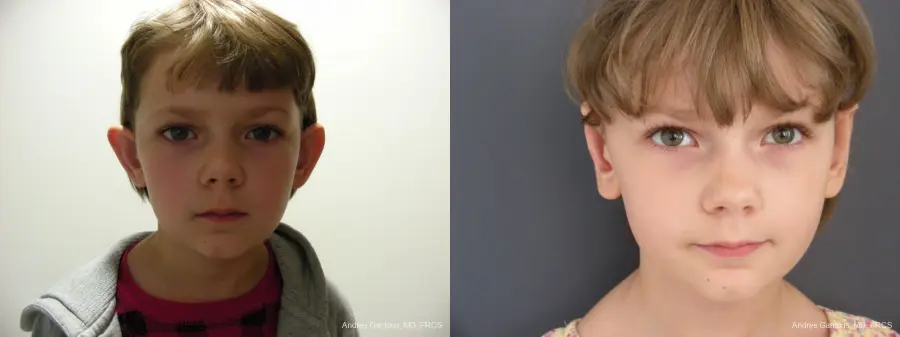 Otoplasty And Earlobe Repair: Patient 27 - Before and After
