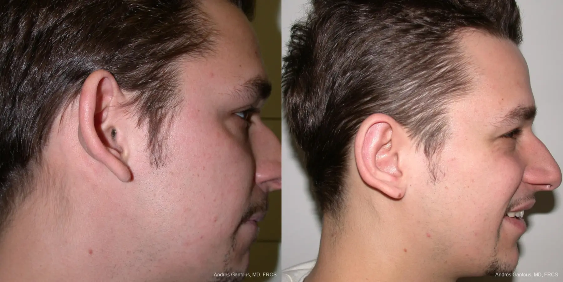 Otoplasty And Earlobe Repair: Patient 1 - Before and After 2