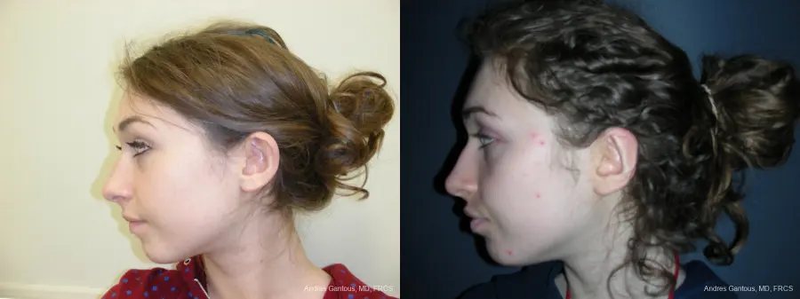 Otoplasty And Earlobe Repair: Patient 22 - Before and After 5