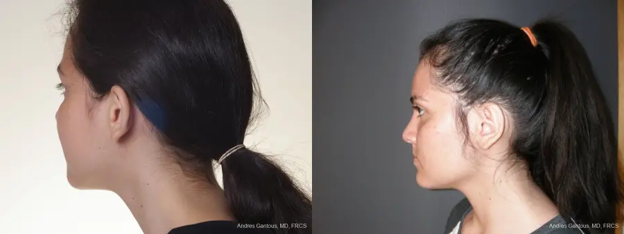 Otoplasty And Earlobe Repair: Patient 20 - Before and After 5