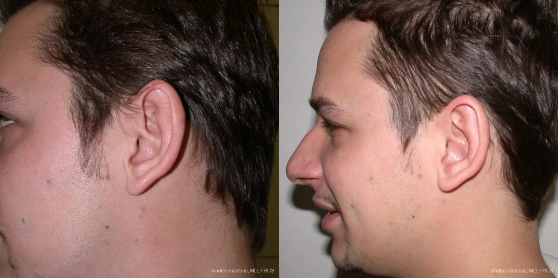 Otoplasty And Earlobe Repair: Patient 1 - Before and After 3